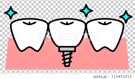 歯医者でインプラント治療して交換した歯のイラスト 113453253