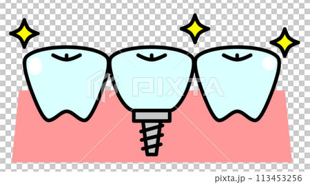 Illustration of teeth replaced by implant treatment at a dentist Illustration of teeth replaced by implant treatment at a dentist 113453256
