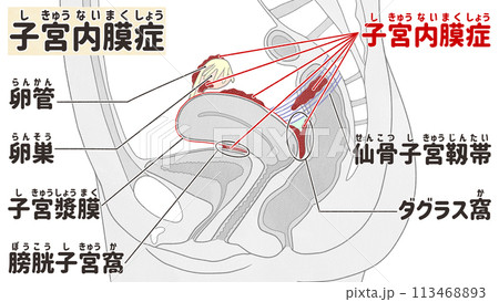子宮内膜症の発生しやすい場所 わかりやすい日本語図解イラスト 子宮内膜症の発生しやすい場所 わかりやすい日本語図解イラスト 113468893