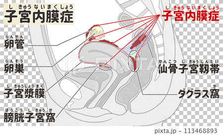 Locations where endometriosis is likely to occur - Easy-to-understand Japanese illustrations Locations where endometriosis is likely to occur - Easy-to-understand Japanese illustrations 113468893