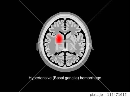 Basal ganglia hemorrhage brain scan illustration Basal ganglia hemorrhage brain scan illustration 113471615