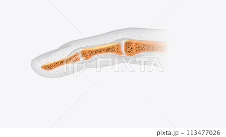 Nail section of bone Nail section of bone 113477026