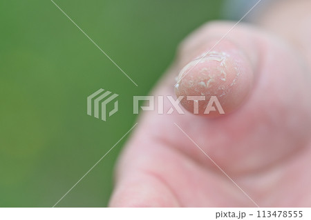 手荒れ　男性　指　手　肌荒れ 113478555