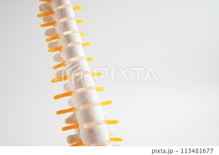 Spinal nerve and bone, Lumbar spine displaced herniated disc fragment, Model for treatment medical in the orthopedic department. 113481677
