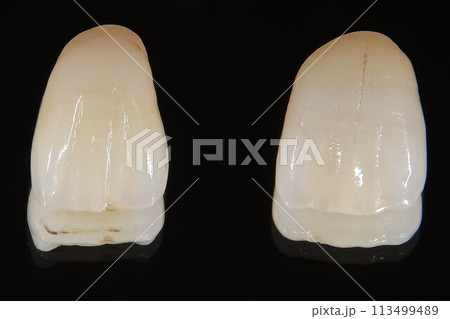 オールセラミッククラウン 113499489