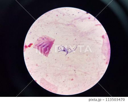 Gram stain.Gram positive cocci in chain. 113503470