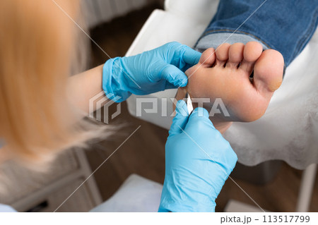 Podologist removing a callus on a womans foot by nippers at the medical center  113517799
