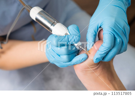 A callus on a womans foot is removed by a podologist using an electric drill at the clinic. 113517805