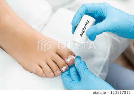 Podologist uses antibiotic after ingrown toenail removal.  113517815