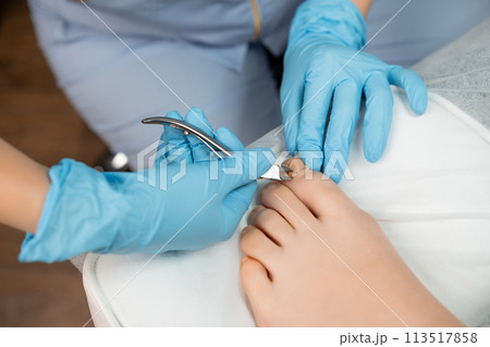 Podiatrist uses nippers cutter to remove ingrown toenail in the clinic. Podiatrist uses nippers cutter to remove ingrown toenail in the clinic. 113517858