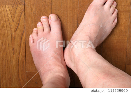 激痛 左足の甲と小指が痛風発作 113539960