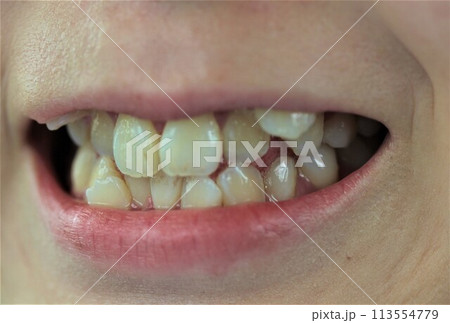 歯並び 歯並び 113554779