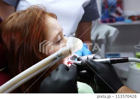 Dental treatment in a child with sedation. A little girl is injected with an inhalation sedative during dental treatment at a dental clinic. Side view. Dental treatment in a child with sedation. A little girl is injected with an inhalation sedative during dental treatment at a dental clinic. Side view. 113570428