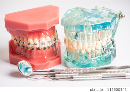 Dental implant, artificial tooth roots into jaw, root canal of dental treatment, gum disease, teeth model for dentist studying about dentistry. Dental implant, artificial tooth roots into jaw, root canal of dental treatment, gum disease, teeth model for dentist studying about dentistry. 113600543
