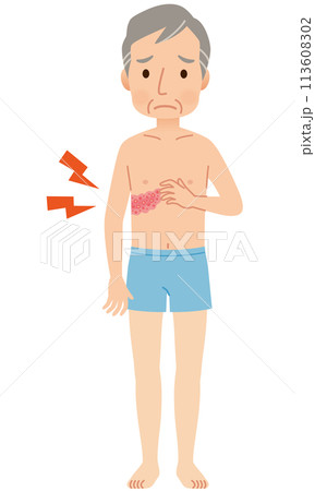 帯状疱疹ができて痛みがある男性　症状 113608302