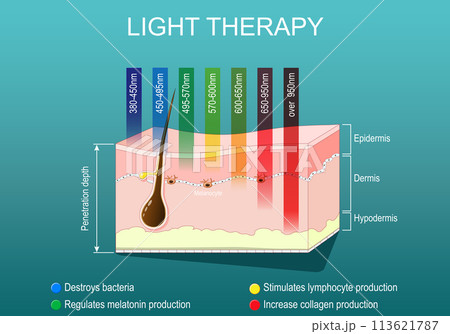 Light therapy. Phototherapy or laser therapy. 113621787