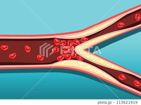 Atherosclerosis artery 113621919