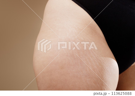 Stretch marks on female legs. A woman's fat Stretch marks on female legs. A woman's fat 113625088