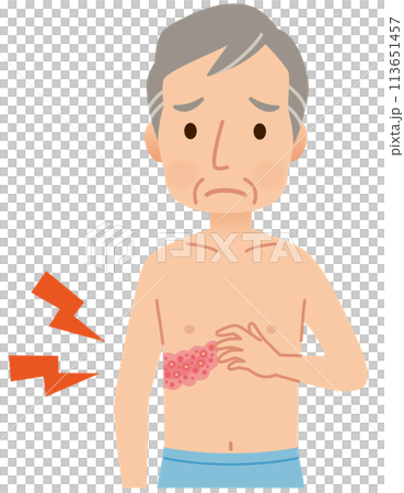 男性因帶狀皰疹而感到疼痛的症狀 113651457