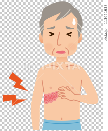 帯状疱疹ができて痛みがある男性　症状 113651638