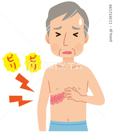 帯状疱疹ができて痛みがある男性　症状 113652199
