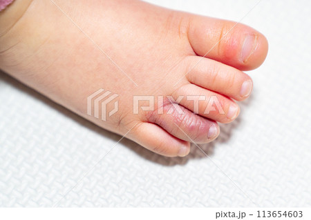しもやけになった幼児の足の写真。 113654603