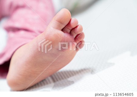 しもやけになった幼児の足の写真。 しもやけになった幼児の足の写真。 113654605
