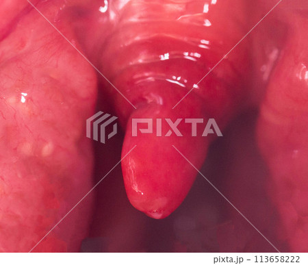 Long uvula with inflammation of infections and viruses. Treatment of uvulitis in children and adults. Sore throat, sore throat, macro. Allergy Long uvula with inflammation of infections and viruses. Treatment of uvulitis in children and adults. Sore throat, sore throat, macro. Allergy 113658222