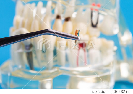 A dental metal pin in tweezers against the background of a medical model of a dental jaw. The concept of installing a dental crown on a post in orthodontics, macro. A dental metal pin in tweezers against the background of a medical model of a dental jaw. The concept of installing a dental crown on a post in orthodontics, macro. 113658253