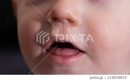 Yellow snot from a child s nose, close-up. Sinus infections, colds and virus. Chronic runny nose, adenoviruses 113658653