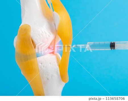 Drug blockade in a mock-up of the knee joint on a blue background. The concept of treating joints with blood plasma, plasma lifting. Introduction of hylaronic acid for joint rejuvenation. Copy space 113658706