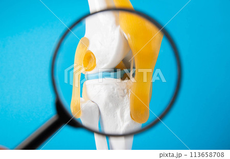 Medical mockup of a knee joint on a blue background under a magnifying glass. Knee joint problems concept. Bursitis, tendonitis and gout. Orthopedics, close-up Medical mockup of a knee joint on a blue background under a magnifying glass. Knee joint problems concept. Bursitis, tendonitis and gout. Orthopedics, close-up 113658708
