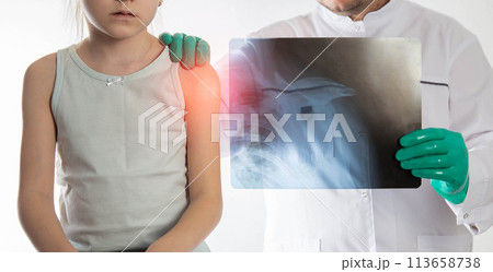 The hands of a doctor orthopedic traumatologist in green gloves holds an x-ray of a girl with a dislocated shoulder and a fracture of the shoulder. Trauma and sprain, close-up The hands of a doctor orthopedic traumatologist in green gloves holds an x-ray of a girl with a dislocated shoulder and a fracture of the shoulder. Trauma and sprain, close-up 113658738