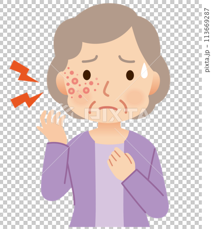 帯状疱疹ができて痛みがある高齢者女性　症状 113669287