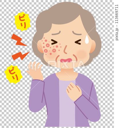 帯状疱疹ができて痛みがある高齢者女性　症状 113669711