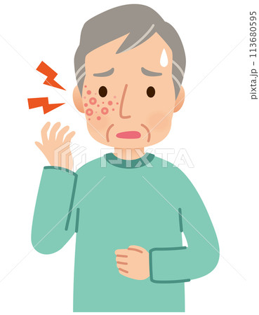 帯状疱疹ができて痛みがある高齢者男性　症状 113680595