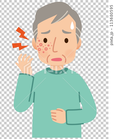 帯状疱疹ができて痛みがある高齢者男性　症状 113680595