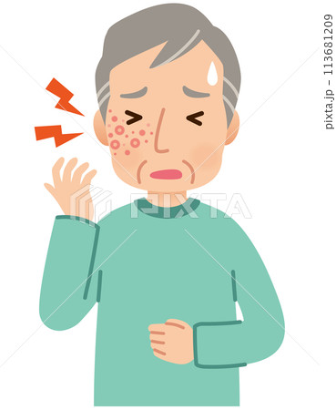 帯状疱疹ができて痛みがある高齢者男性　症状 113681209