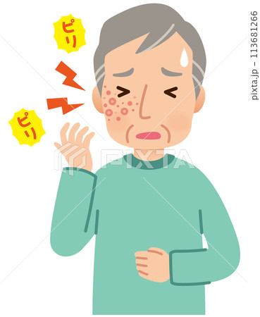 帯状疱疹ができて痛みがある高齢者男性 症状 帯状疱疹ができて痛みがある高齢者男性 症状 113681266