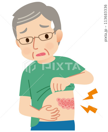 帯状疱疹ができて痛みがある高齢者男性　症状 113683336