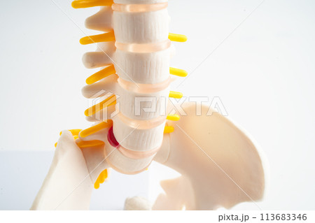 Lumbar spine displaced herniated disc fragment, spinal nerve and bone. Model for treatment medical in the orthopedic department. Lumbar spine displaced herniated disc fragment, spinal nerve and bone. Model for treatment medical in the orthopedic department. 113683346