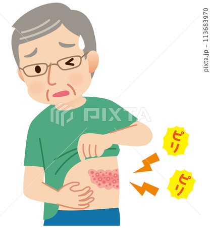 帯状疱疹ができて痛みがある高齢者男性　症状 113683970