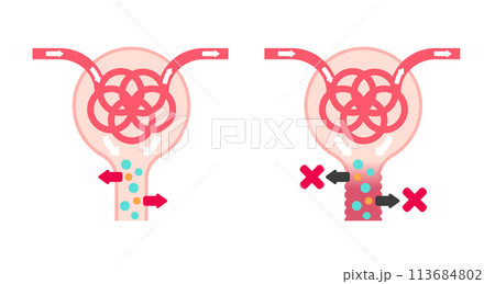 ファンコーニ症候群 の原因と仕組み ベクターイラスト(文字なし) 113684802