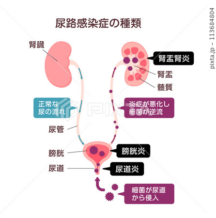 尿路感染症の種類 ベクターイラスト 113684804