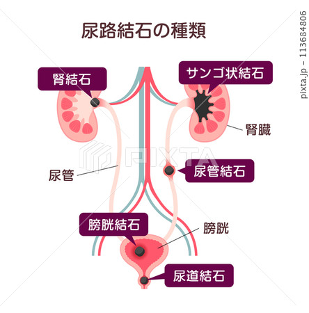 尿路結石の種類 ベクターイラスト 113684806