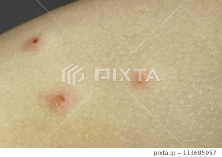 Scratched pimples on human skin. Infectious disease. Dermatology, medicine and health care concept. Scratched pimples on human skin. Infectious disease. Dermatology, medicine and health care concept. 113695957
