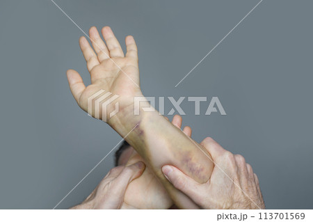 Domestic violence and abuse concept. Female hand with bruise 113701569