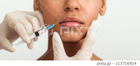 Close-up view of filler injection in lips 113716924