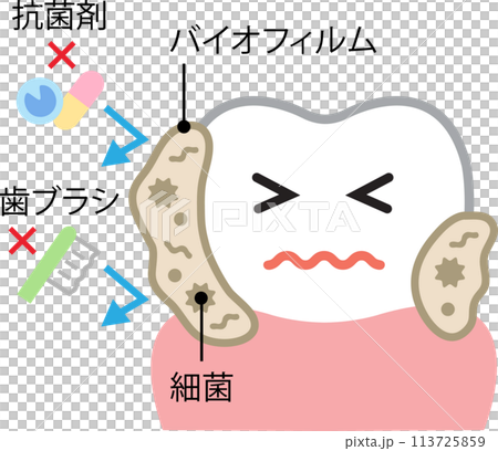 歯のバイオフィルム 113725859