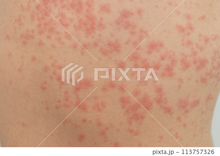 Urticaria is an allergic reaction on the skin. Red spots on the skin 113757326